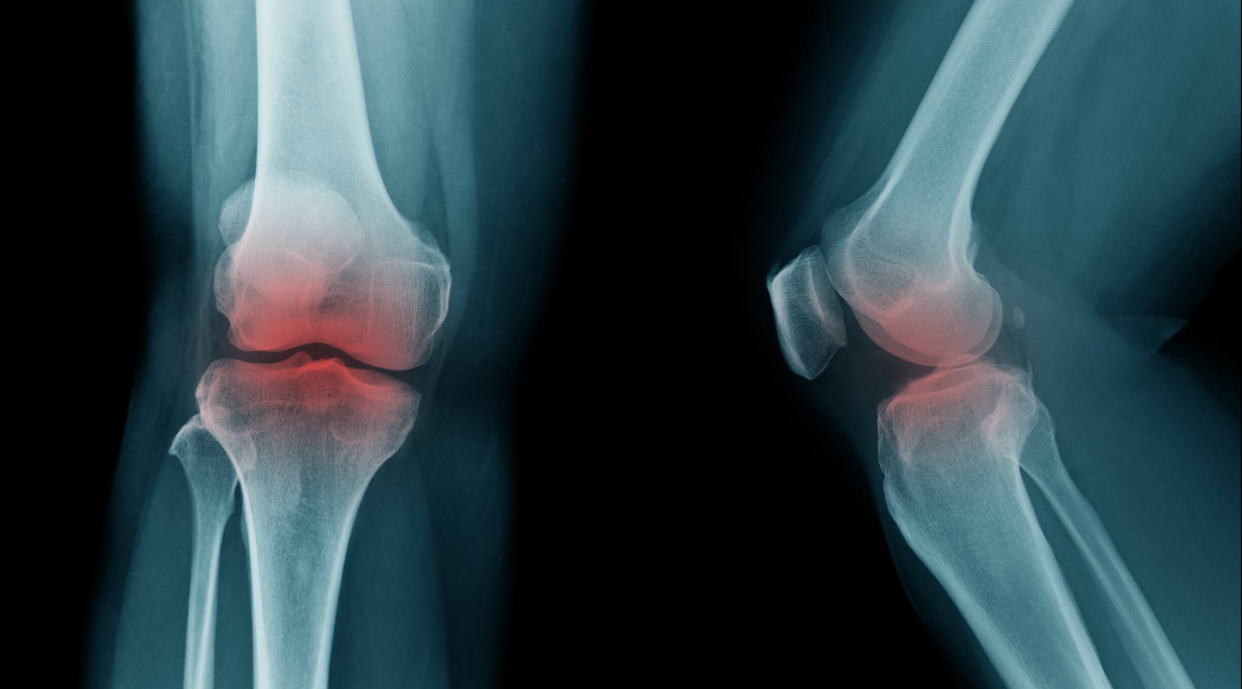 Артроз колінного суглобу, рентген