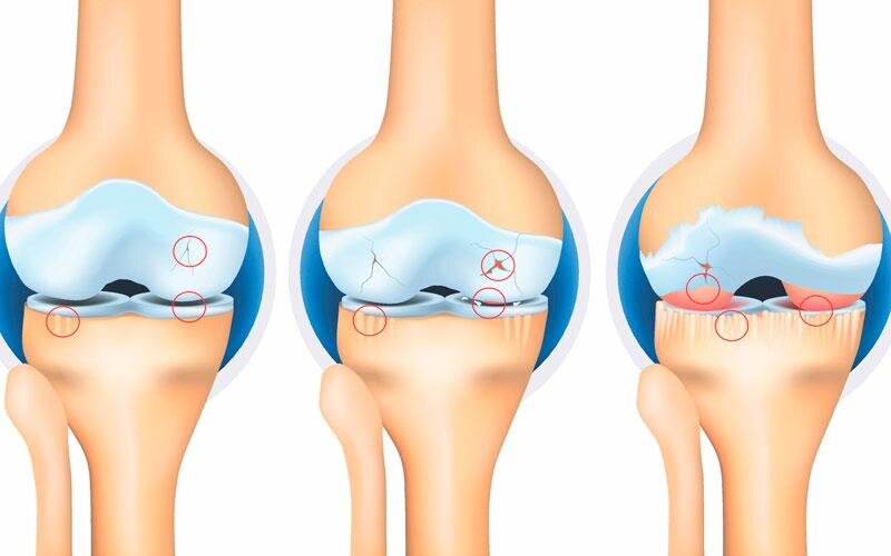Стадії гонартрозу, артрозу колінного суглобу