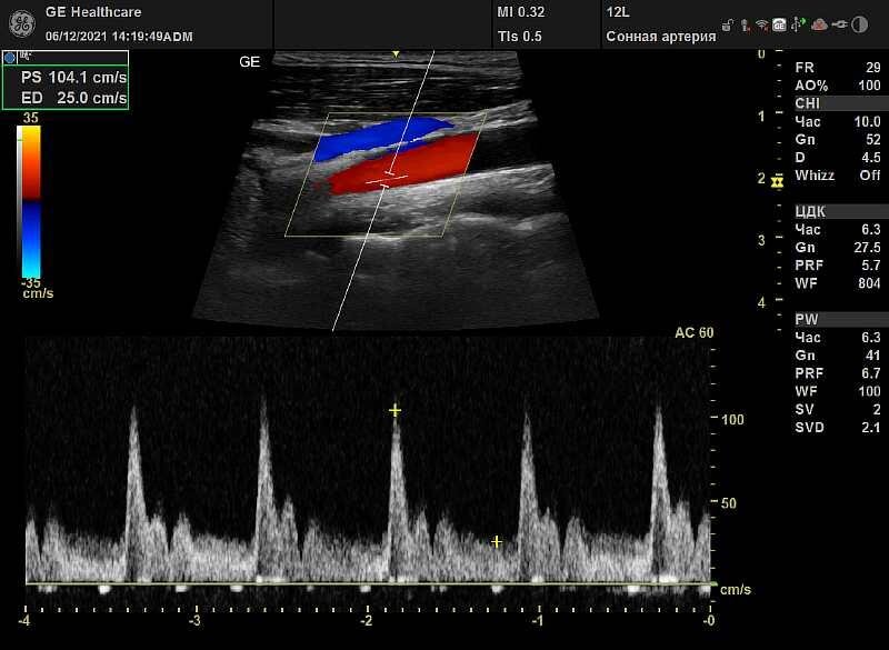 УЗИ сосудов шеи Харьков ХТЗ